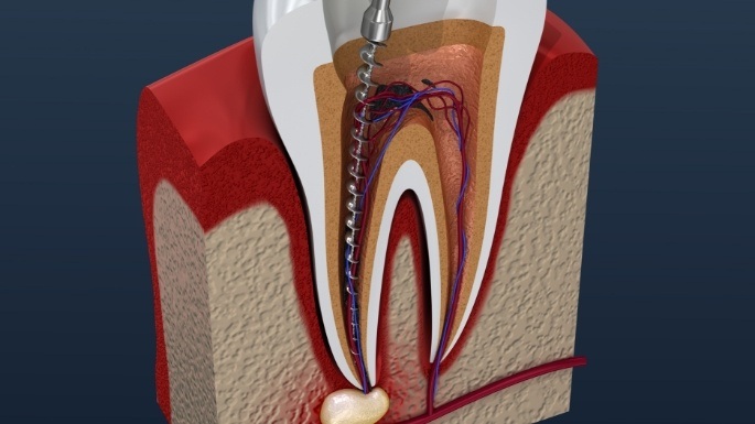Animated tooth during pulp therapy procedure