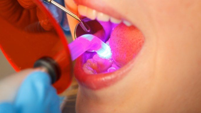 Dental patient receiving dental bonding treatment