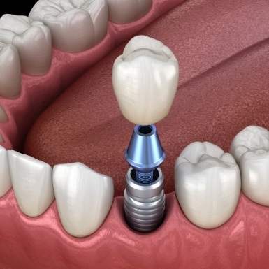 Animated dental crown being placed onto a dental implant