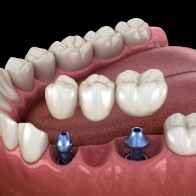 Animated dental bridge being placed onto two dental implants