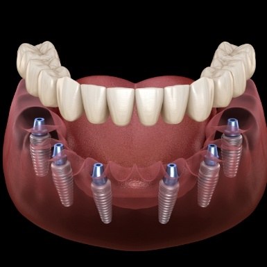 Animated denture being placed onto six dental implants