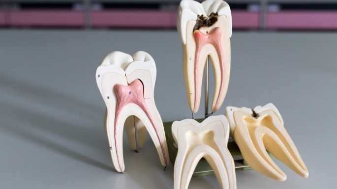 Model of healthy tooth and model of damaged tooth