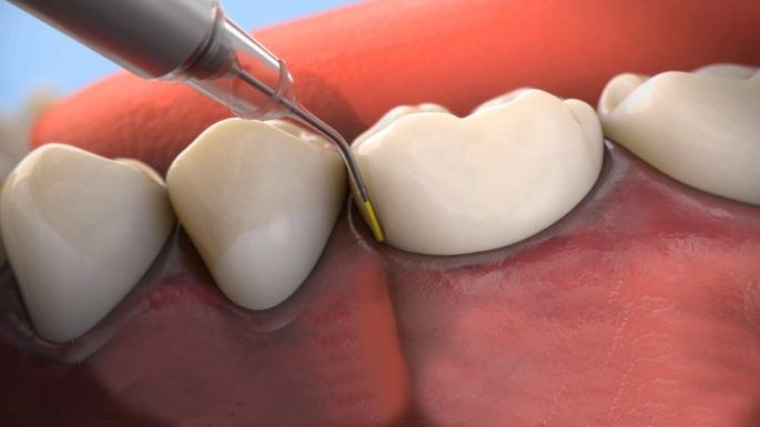 Animated dental tools treating diseased gums