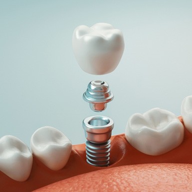A 3 D illustration of dental implant parts